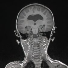 Holoprosencephaly Coronal MRI showing a failure of separation of the cerebral hemispheres in holoprosencephaly