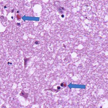HSV Encephalitis HSV encephalitis pathology slide with Cowdry bodies of intranuclear eosinophilic inclusions of nucleic acid