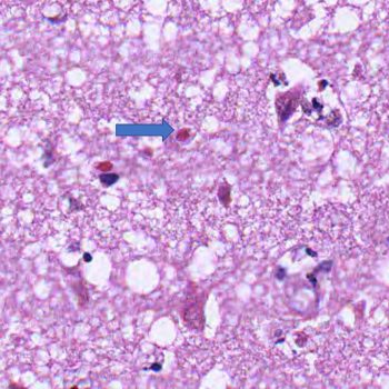 HSV Encephalitis H&E stains showing Cowdry bodies (intranuclear eosinophilic inclusions of nucleic acid)