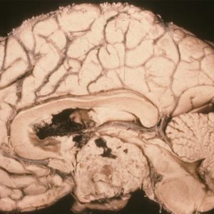 Craniopharyngioma Craniopharyngioma sagittal cut gross specimen with lesion arising from the region of the hypophyseal stalk with both solid and cystic areas