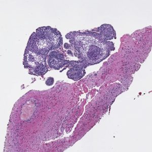 Craniopharyngioma Craniopharyngioma pathology specimen showing Encapsulated tumor with well differentiated nonkeratinizing squamous epithelium and papillary fibrovascular stroma