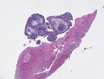 Craniopharyngioma Craniopharyngioma pathology specimen showing Encapsulated tumor with well differentiated nonkeratinizing squamous epithelium and papillary fibrovascular stroma