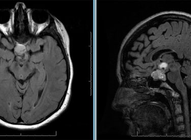 Craniopharyngioma Craniopharyngioma on axial and sagittal MRI with T1 with contrast and FLAIR