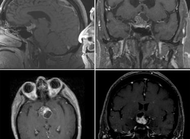 Craniopharyngioma Craniopharyngioma on MRI T2 flair and T1 with contrast