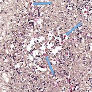 Cryptococcal Meningitis Neuroinfectious disease Cryptococcal Meningitis Pathology Slide