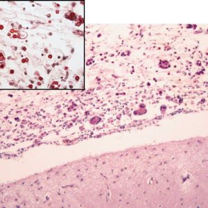 Cryptococcal Meningitis Microscope pathology of cryptococcus on mucicarmine stain