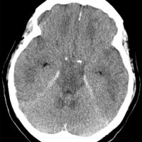Diffuse Hypoxic Damage after Cardiac Arrest Diffuse Hypoxic Damage on CT after Cardiac Arrest