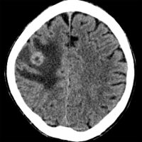 Brain Metastasis on axial CT scan