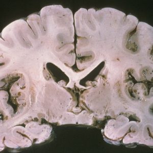Cryptococcal Meningitis Coronal section with numerous small intraparenchymal cysts located mostly in the superficial cortex with a few in deep gray matter, consistent with Cryptococcal Meningitis