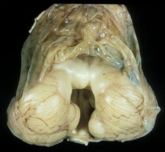 Dandy-Walker Malformation Gross pathology of dandy-walker malformation
