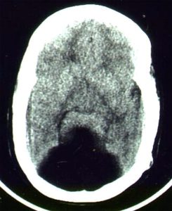 Dandy-Walker Syndrome Dandy-Walker Syndrome hypoplastic vermis on CT head