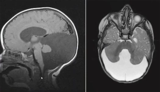 Dandy-Walker Cyst Dandy Walker Cyst on sagittal and axial MRI