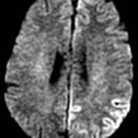 Creutzfeldt-Jakob Disease (CJD) MRI of patient with Creutzfeldt-Jakob Disease showing cortical ribboning