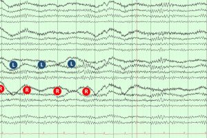 Lateral Eye Movement Artifact on EEG Lateral Eye Movement Artifact on EEG