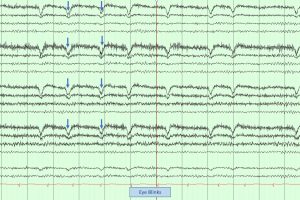 Eye Blink Artifact on EEG Eye blink Artifact on EEG