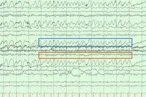 Eye flutter artifact on EEG Eye flutter artifact on EEG