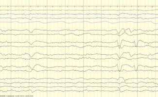 Frontal Sharps EEG review EEG tracing showing frontal sharps in neonate