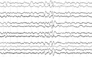 Frontal Sharps EEG review frontal sharps in neonate on EEG tracing