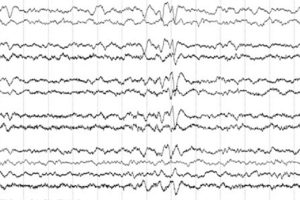 Frontal Sharps EEG review frontal sharps in neonate on EEG tracing