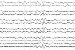 normal eeg tracing