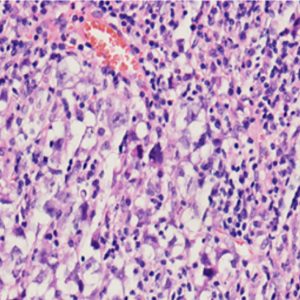 Germinoma H&E stained, low magnification image showing large round neoplastic cells with clear cytoplasm consistent with germinoma