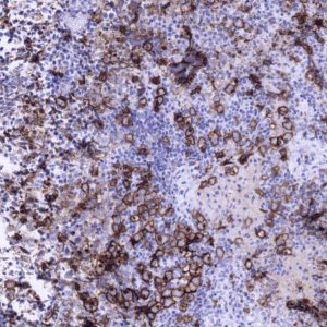 Germinoma Germinoma pathology slide Medium power view cKIT stain (tumor marker) showing small reactive lymphocytes and large neoplastic germ cells that stain positively
