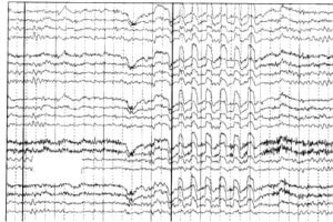 Glossokinetic artifact EEG with Glossokinetic artifact