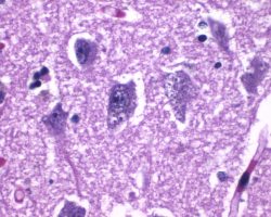 Granulovacuolar degeneration Granulovacuolar degeneration in Alzheimer's disease. Medium power H&E image showing intraneuronal accumulations of large vacuoles harboring a central granule.