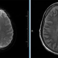 Hypoxic Ischemic Encephalopathy Hypoxic Ischemic Encephalopathy on DWI MRI after cardiac arrest