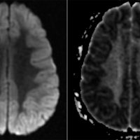 Hypoxic Ischemic Encephalopathy Hypoxic Ischemic Encephalopathy on DWI and ADC MRI with diffuse diffusion restriction