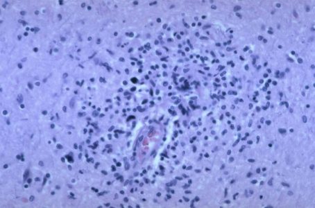 HIV Brain Biopsy Neuroinfectious disease HIV Brain Biopsy pathology slide with perivascular macrophages and multinucleate giant cells in white matter