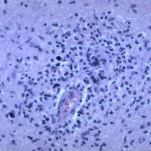 HIV Brain Biopsy Neuroinfectious disease HIV Brain Biopsy pathology slide with perivascular macrophages and multinucleate giant cells in white matter