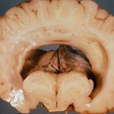 Alobar Holoprosencephaly Coronal section of the brain showing alobar holoprosencephaly.
