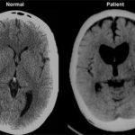 Huntington's Disease Huntington's Disease CT head with caudate atrophy