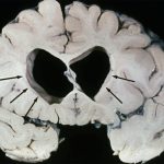 Huntington's Disease Huntington's Disease gross specimen with caudate atrophy