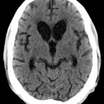 Huntington's Disease Huntington's Disease CT showing bilateral caudate atrophy.