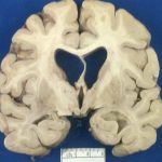 Huntington's Disease Huntington's Disease Gross specimen with bilateral caudate atrophy