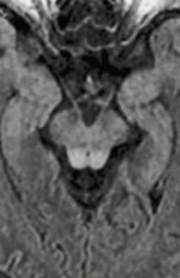 Wernicke's Encephalopathy Wernicke's Encephalopathy on T2 FLAIR MRI showing hyperintensity of the periaqueductal grey