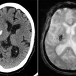 Right Lentiform Nucleus Hemorrhage secondary to hypertension. Right Lentiform Nucleus Hemorrhage on axial CT and MRI