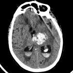 Intracerebral Hemorrhage of Left Thalamus Intracerebral Hemorrhage of Left Thalamus on CT head