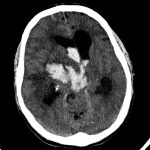Intracerebral Hemorrhage of Right Putamen Secondary to Hypertension Intracerebral Hemorrhage of Right Putamen on CT head