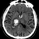 Intracerebral Hemorrhage of Right Thalamus Intracerebral Hemorrhage of Right Thalamus on CT head