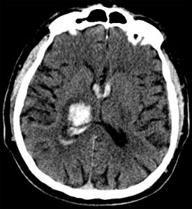 Intracerebral Hemorrhage of Right Thalamus Intracerebral Hemorrhage of Right Thalamus on CT head