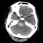 Hypertensive Pontine Hemorrhage Hypertensive Pontine Hemorrhage on CT head axial