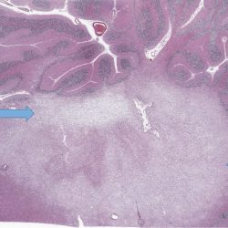 Hypocellular Multiple Sclerosis Plaque Hypocellular Multiple Sclerosis Plaque H&E stain, Low power view, showing a sharply-demarcated hypocellular plaque