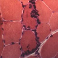 Inclusion Body Myositis Inclusion Body Myositis biopsy with lymphocyte invasion