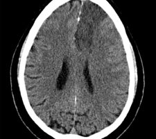 Left ACA Infarct Chronic Left ACA Infarct on axial head CT