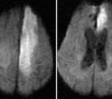 Left ACA Infarct Left ACA Infarct on MRI DWI