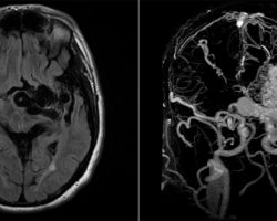 Left Arteriovenous Malformation (AVM) Left arteriovenous malformation (AVM) on brain MRI