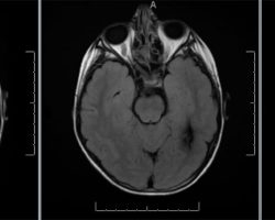 Left Cavernous Malformation Left Cavernous Malformation on MRI brain axial cut